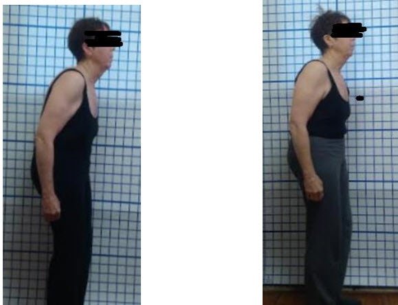 Radiografías antes y después — escoliosis adulto mayor